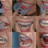 bite ripara anello linguale