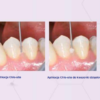 Chlosite gel per le tasche parodontali e perimplantari